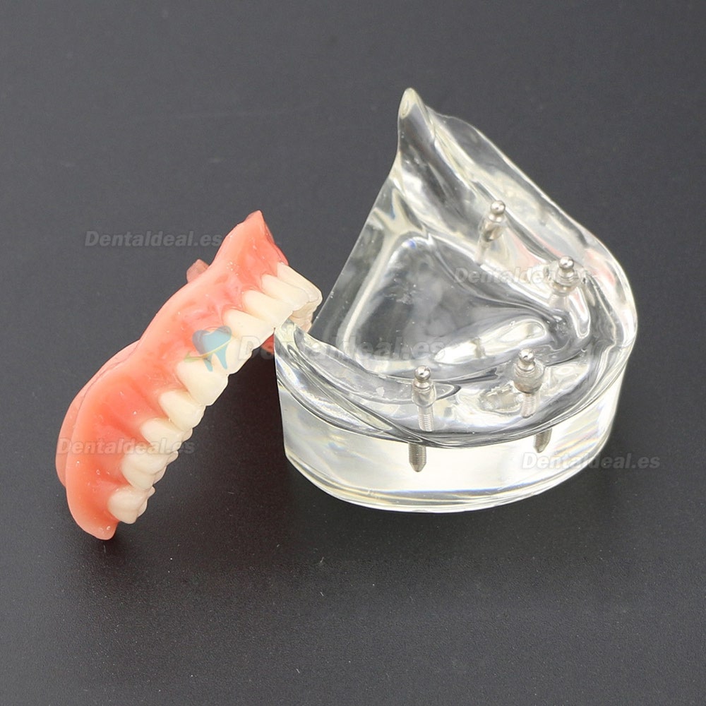 Dientes inferiores dental Modelo de sobredentadura 4 implantes Demostración Modelo 6002 02